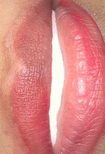 Lip correction and the healing process.