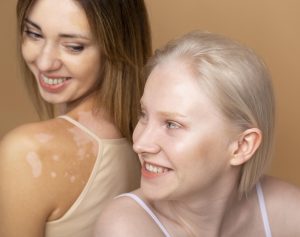 Two smiling young women, one with Vitiligo before Scar Camouflage treatment. 