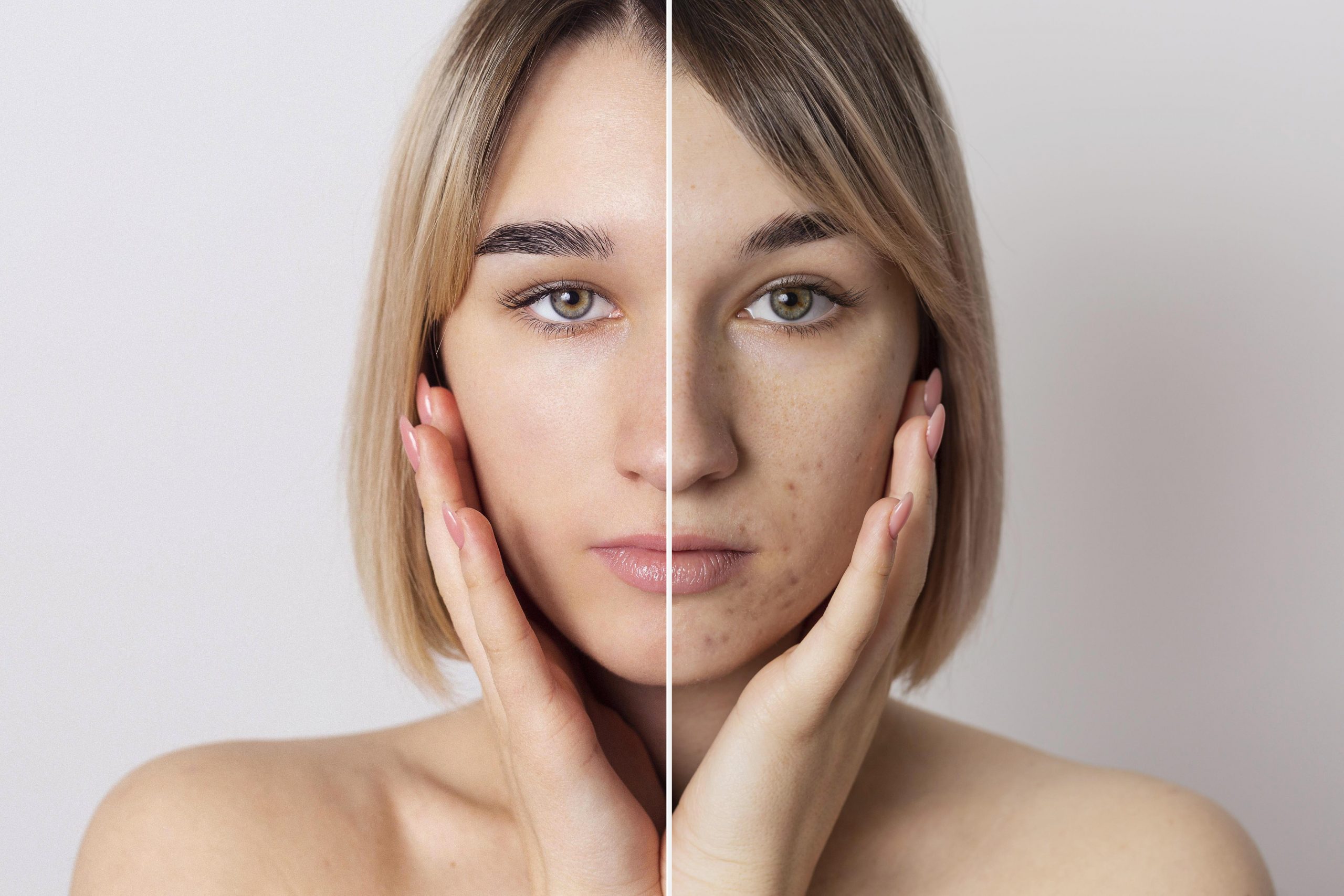 Young woman with acne before and after camouflage tattoo treatment.