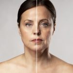 Before and after portrait of anti-wrinkle treatment on a mature woman.