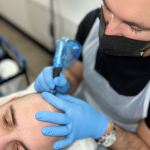 Scalp Micropigmentation being performed on a male model.