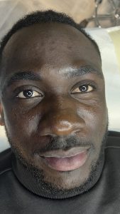 A black male after eyebrow enhancement.