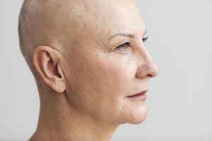 Portrait of a woman with cancer who is a suitable candidate for Scalp Micropigmentation.